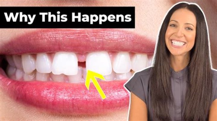 Are Gap Teeth Lucky? – Celebrity