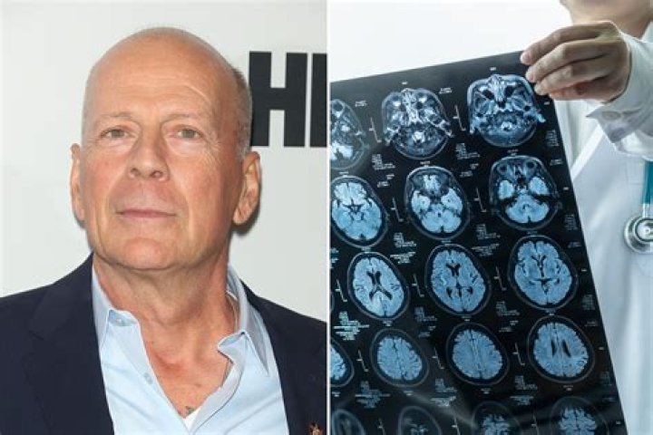 Bruce Willis heart attack and health update 2023