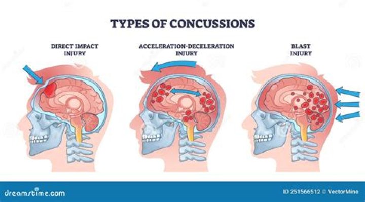 How did Jamie Johnson get a concussion?