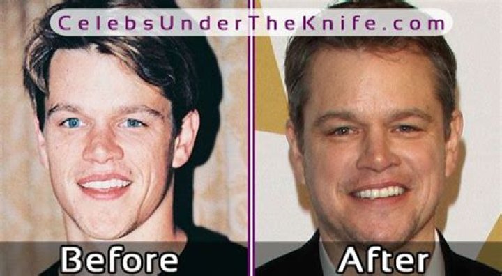 Matt Damon Plastic Surgery Before and After